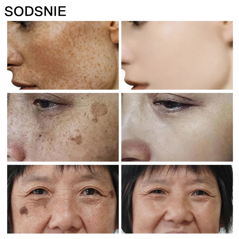 Dark Spot Remover Vitamin C Wh - Skincare Niacinamide reseña y precio