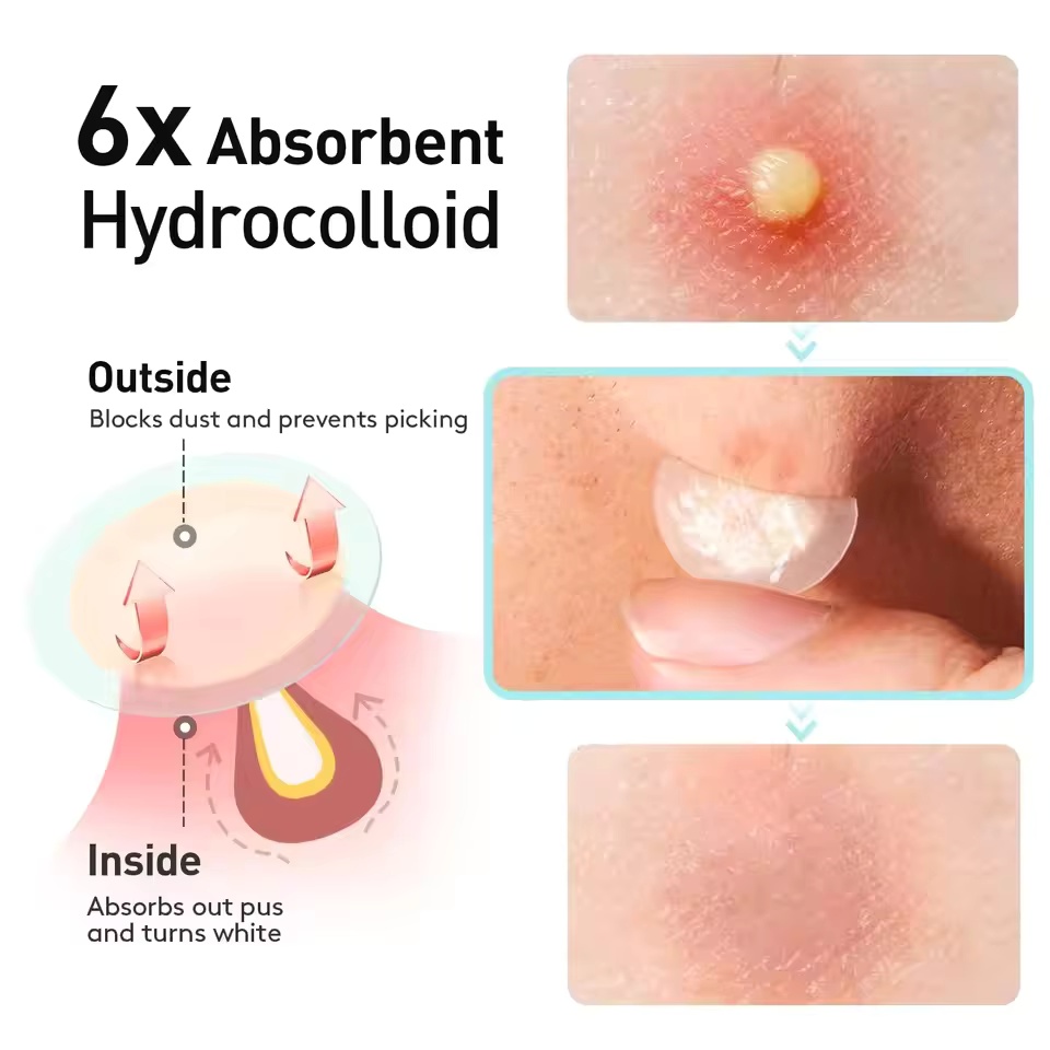 443pcs water-based gel acne pa - Skincare You reseña y precio